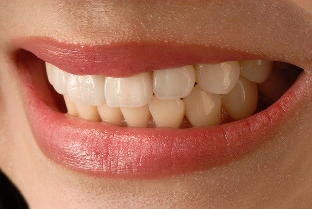 Dental veneers look incredible