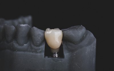 Dental Crowns