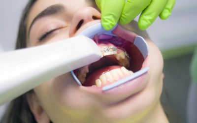 Teeth Straightening