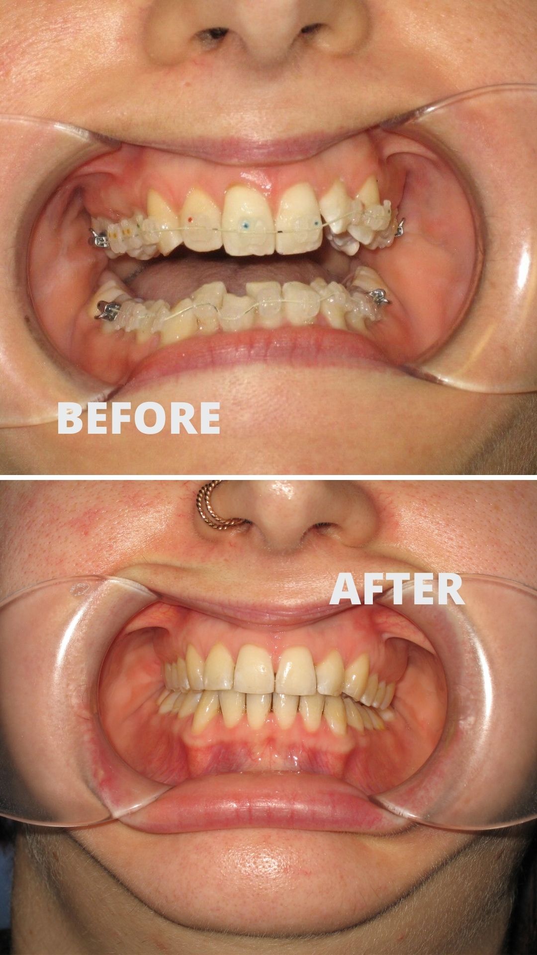 Before and after orthodontic treatment