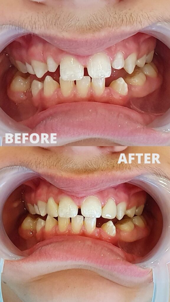 Before and after composite bonding