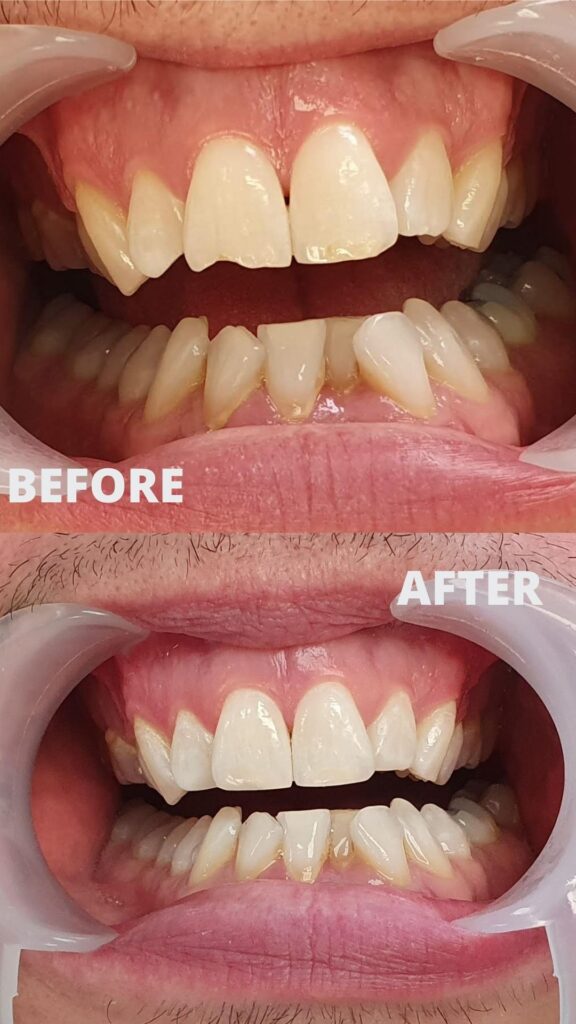 Before and after composite bonding