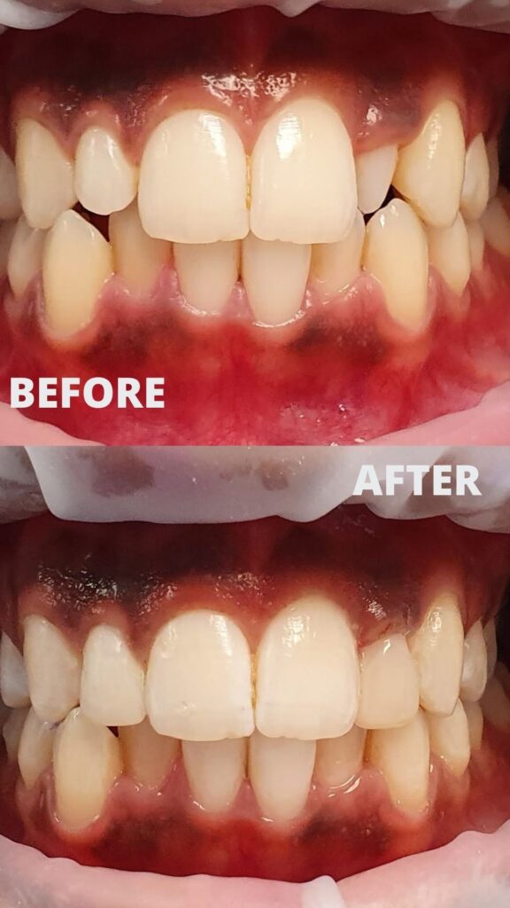 Before and after composite bonding