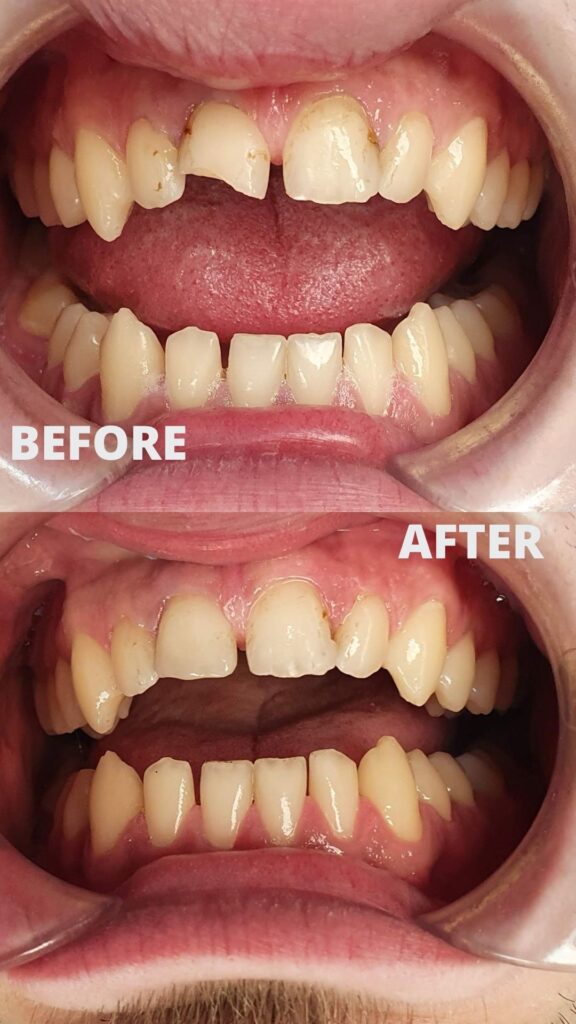 Before and after composite bonding