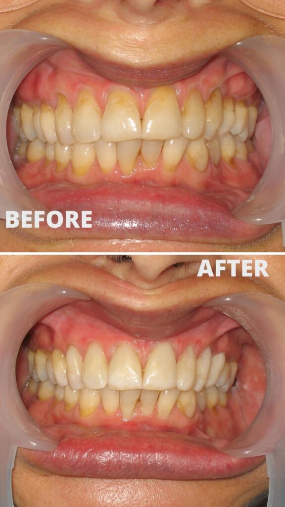 Before and after composite bonding