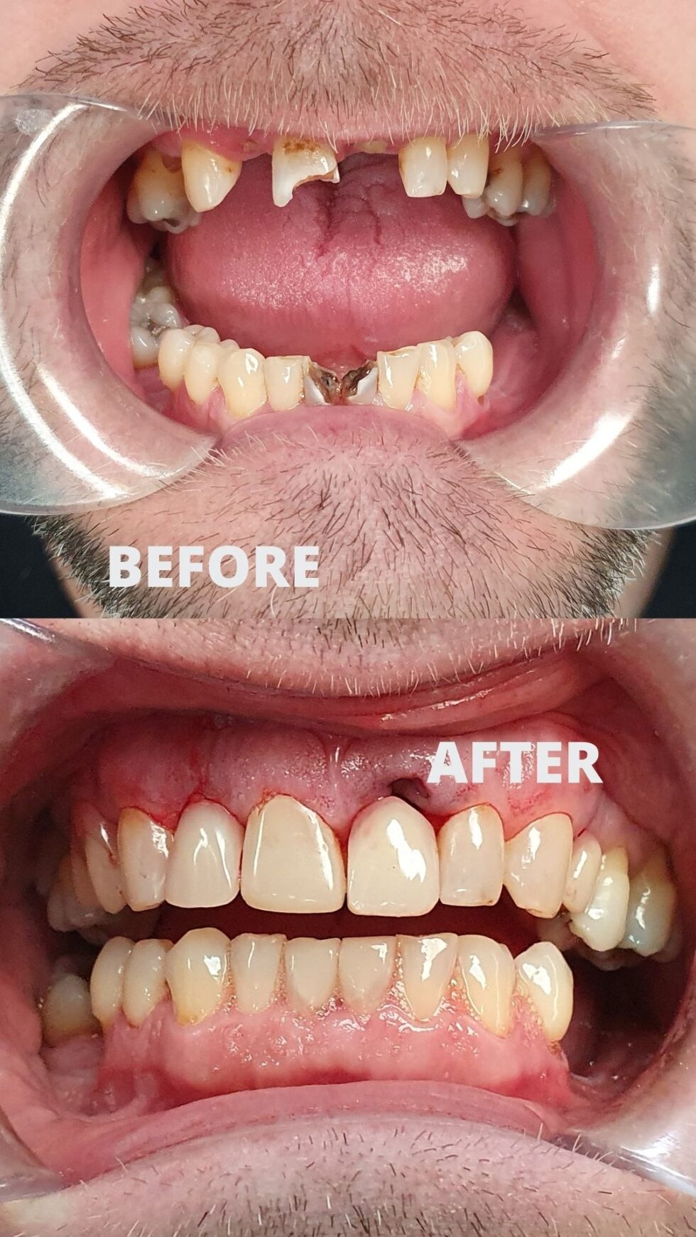 Composite Bonding StokeonTrent Dental Bonding