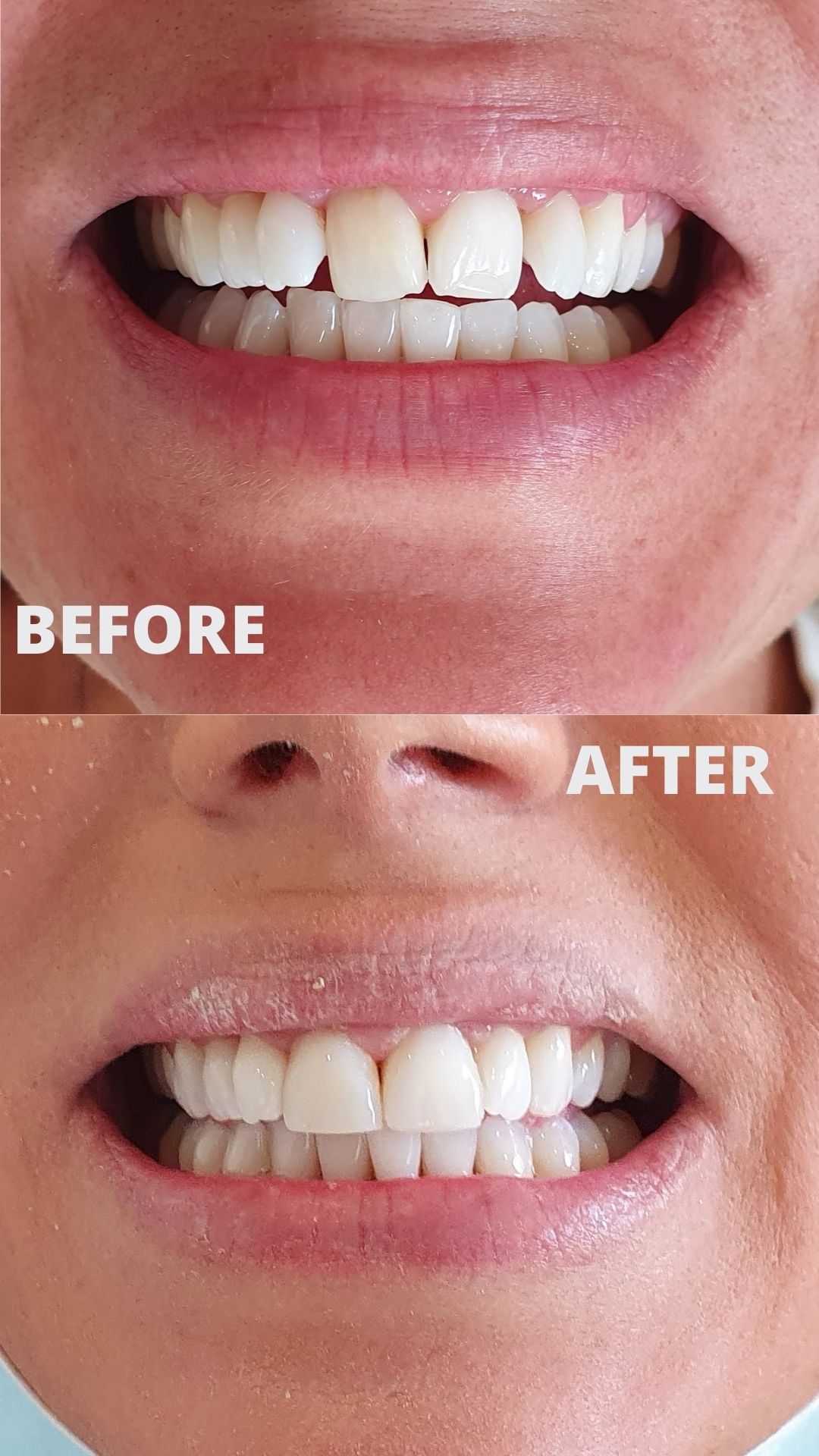 Before and after composite veneers