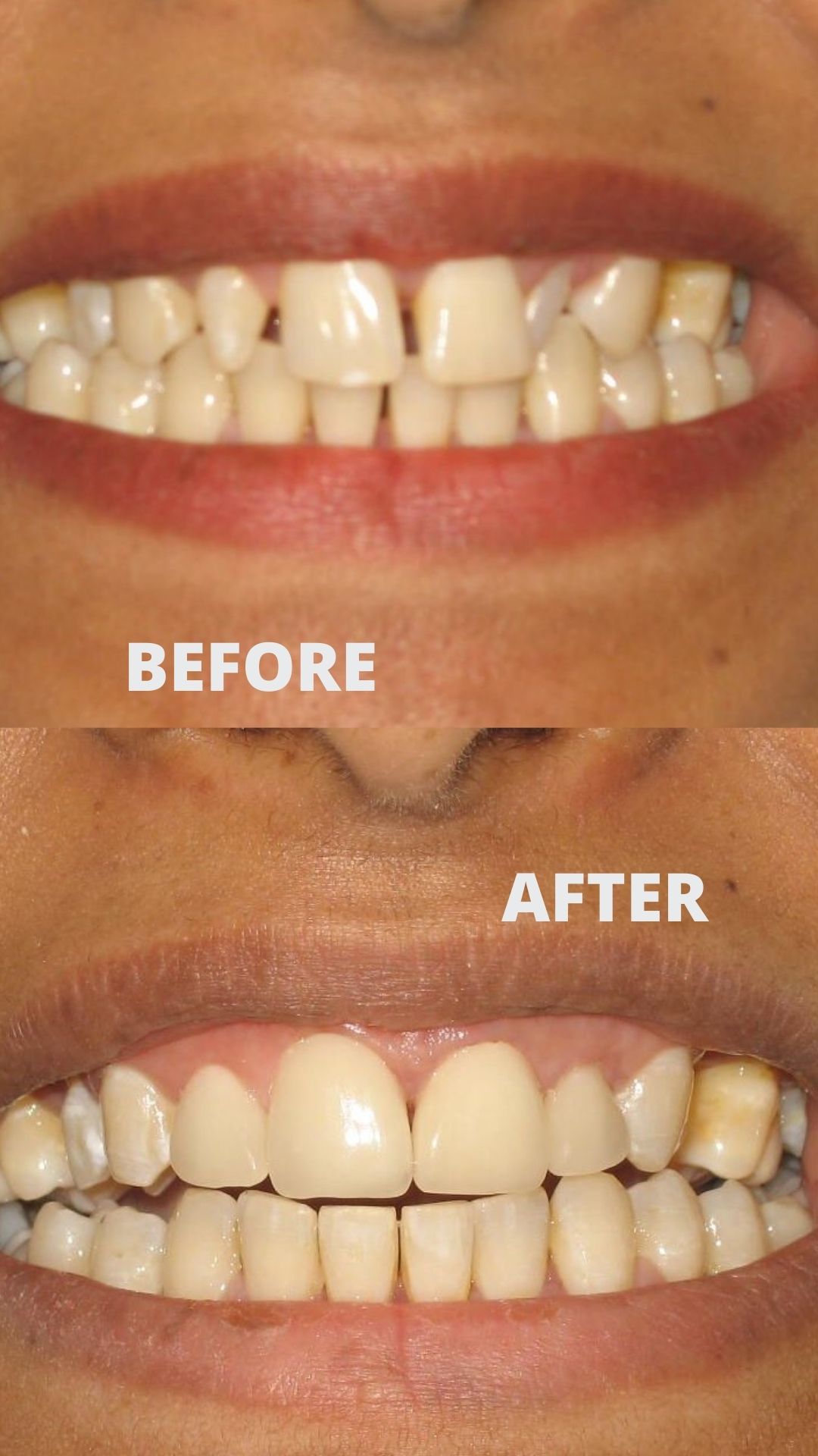 Before and after porcelain veneers