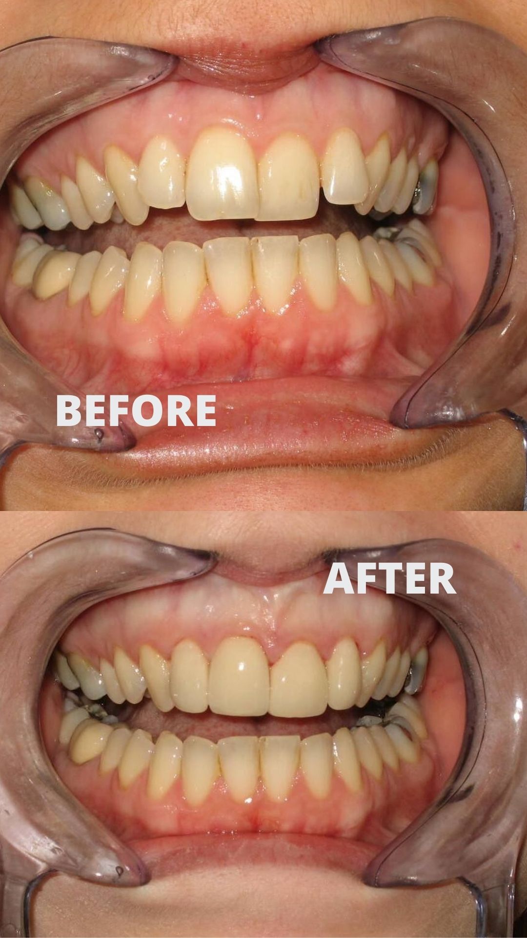 Before and after porcelain veneers