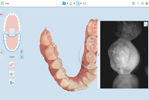 3D impression from iTero scanner