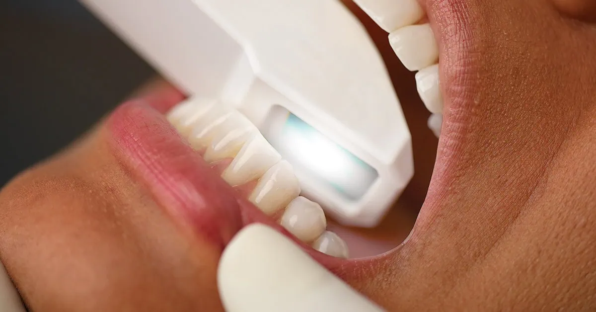 iTero Dental Scanner used in teeth straightening patient