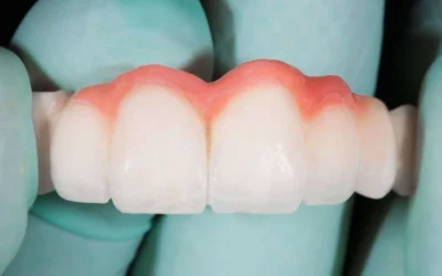 Dental Bridges