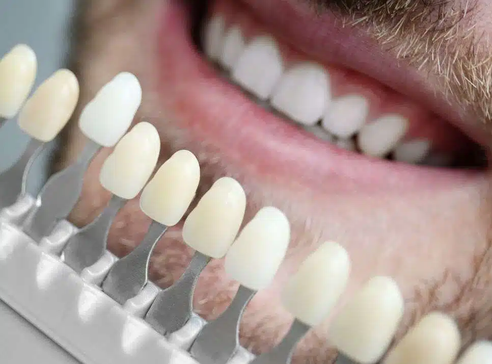 A selection tooth-like colours shown to a patient for their veneers