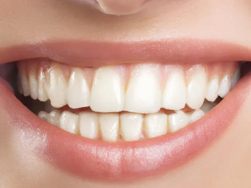 Teeth whitening will make your smile more attractive