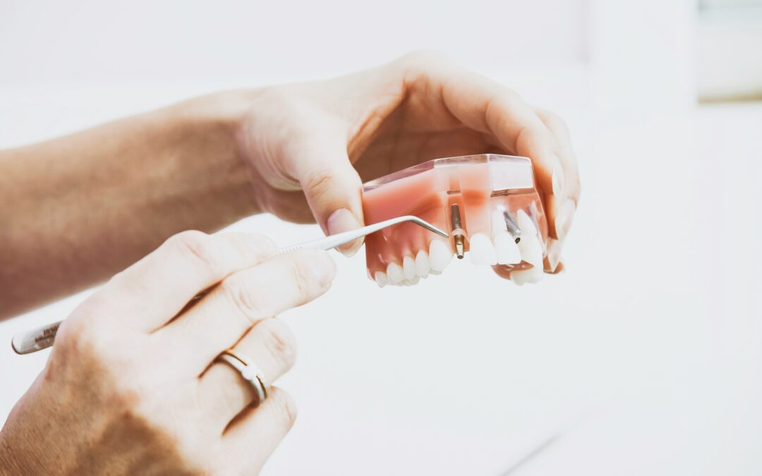 How Long Do Dental Veneers Last?