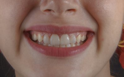 How to Treat Swollen Gums