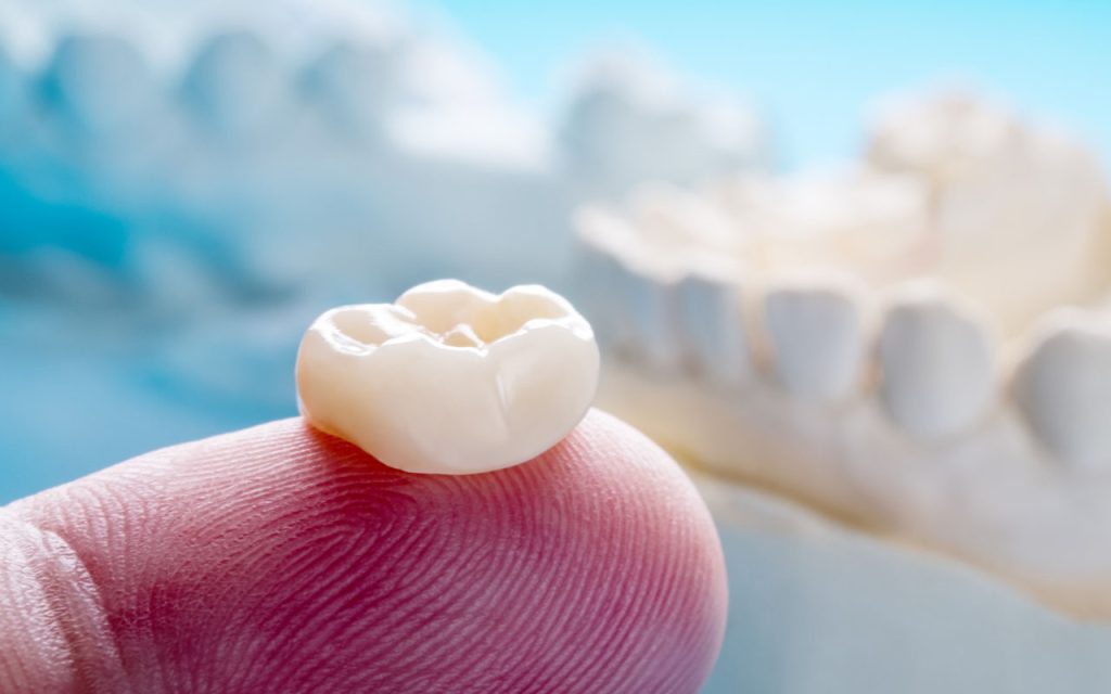 How Long Do Crowns Last on a Tooth?