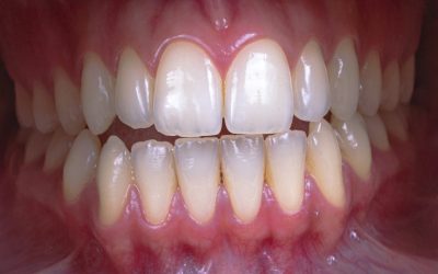 How to Choose the Right Shade for Veneers