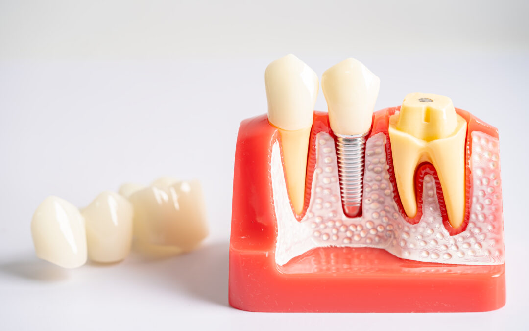 What Can You Put a Crown On?