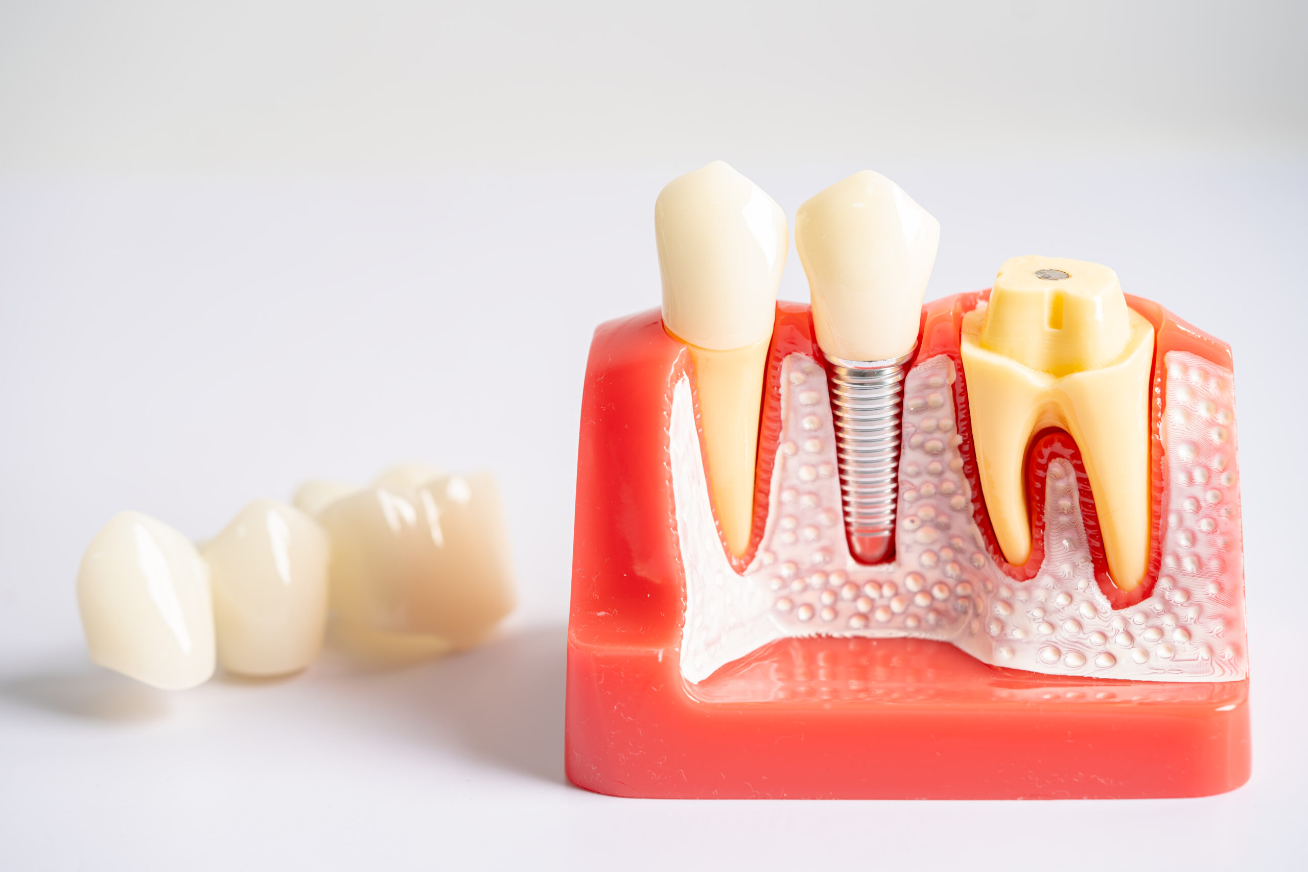 Dental implant, artificial tooth roots into jaw, root canal of dental treatment, gum disease, teeth model for dentist studying about dentistry.