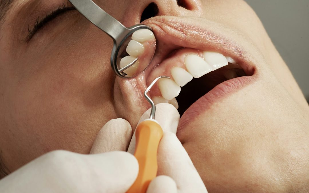 What Are The Side Effects of Air Flow Teeth Cleaning?