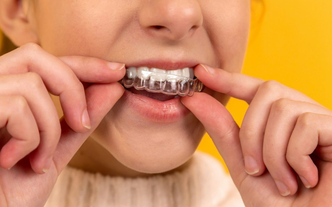 How to Clean Invisalign Aligners