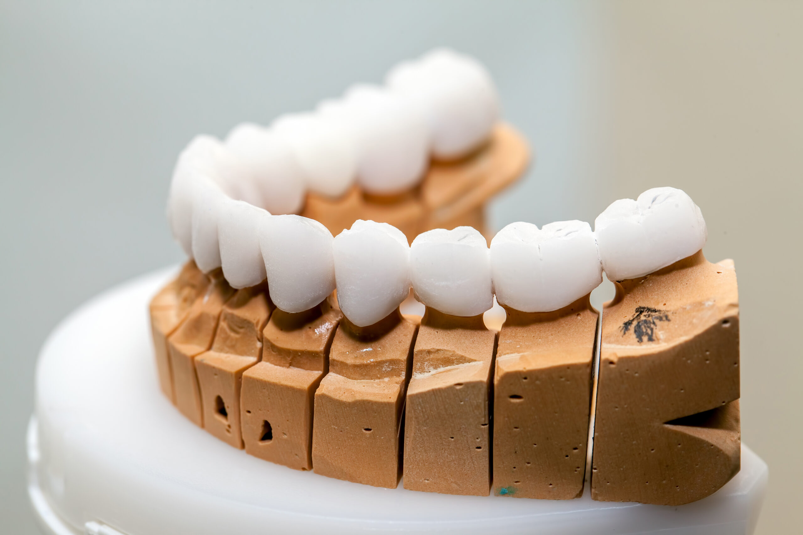 Dentist holding a clay model of a dental bridge on a set of teeth